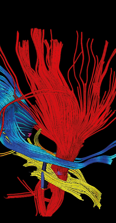 Advanced medical imaging scans showing brain glioblastoma tumor in colorful diagnostic views